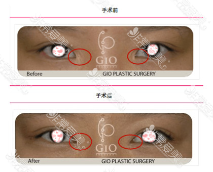 韩国GIO整形外科开眼角修复案例