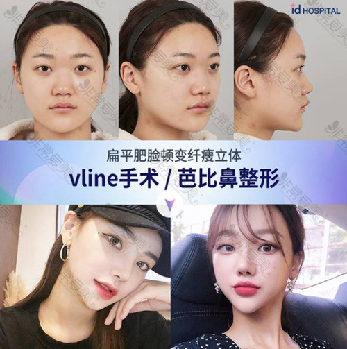 韩国ID医院Vline手术对比