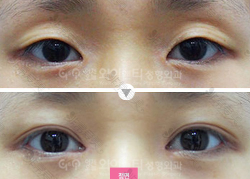 韩国YNT整形医院眼部整形案例