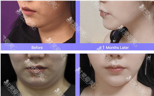 韩国清潭优整形外科双下巴吸脂对比照片