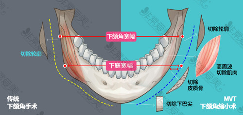 韩国ID医院下颌角手术方法演示
