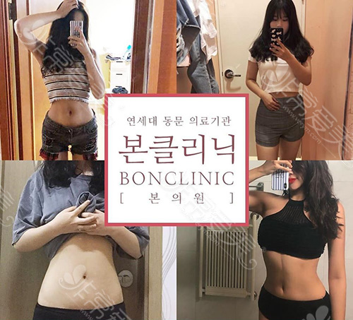 韩国bon整形外科腹部吸脂案例