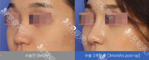 韩国dream整形外科鼻部案例