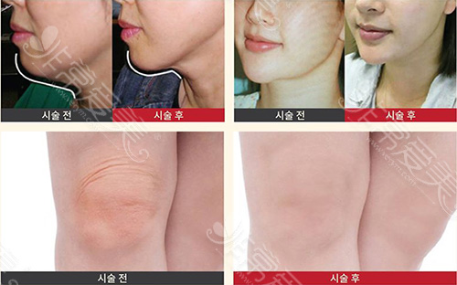 韩国爱丽美女性医院吸脂手术案例