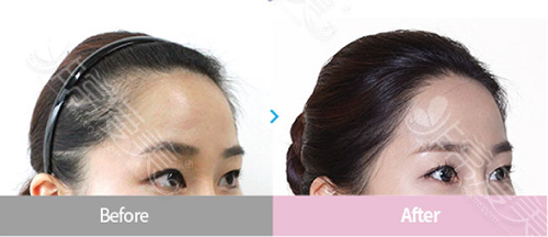 女性M型发际线与植发后对比