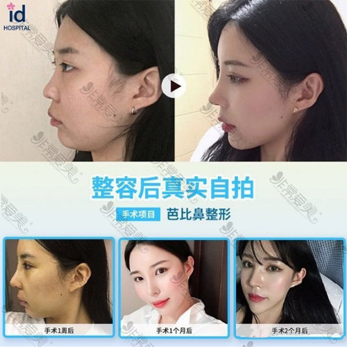 韩国ID整形外科鼻部整形案例