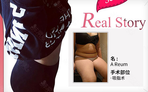 韩国然美之整形腰腹吸脂图片