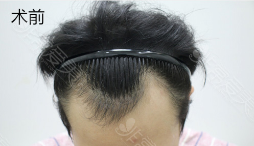 韩国forhair头发种植7个月效果变化图 成活率误区你知道多少?