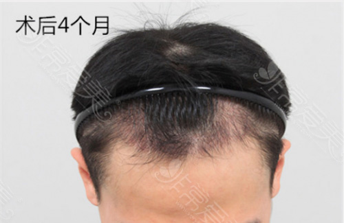 韩国forhair植发中心术后4个月效果图