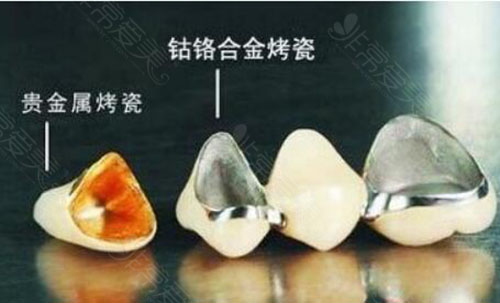 不同材质的牙齿照片