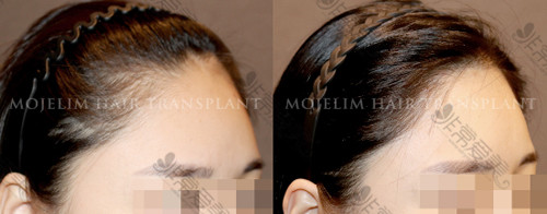 韩国毛杰琳整形外科毛发移植案例
