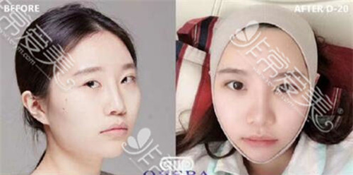 三组脸部整形对比照片示例:韩国欧佩拉改善面部轮廓怎么样