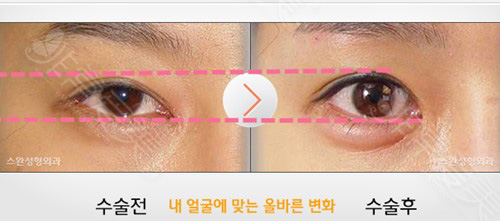 韩国swan医院双眼皮手术前后对比图