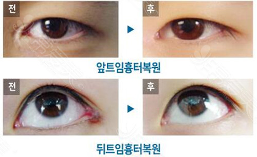 双眼皮手术风格照片