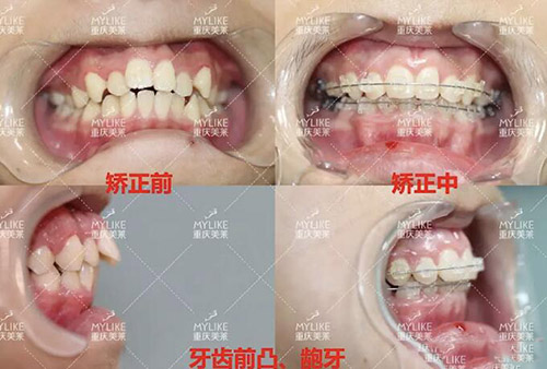 牙齿不齐,在重庆带个牙套要多钱?其实没你想象那么贵!