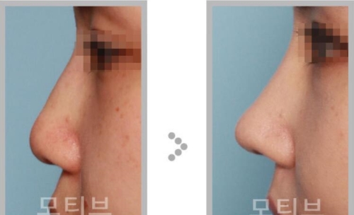 韩国MOTIVE整形外科隆鼻案例