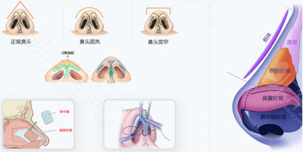 鼻整形结构图