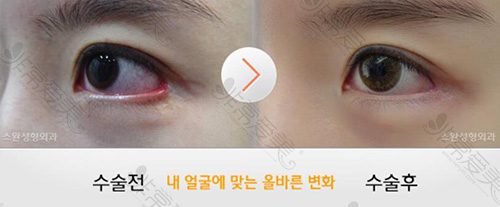 韩国天鹅整形外眼角修复