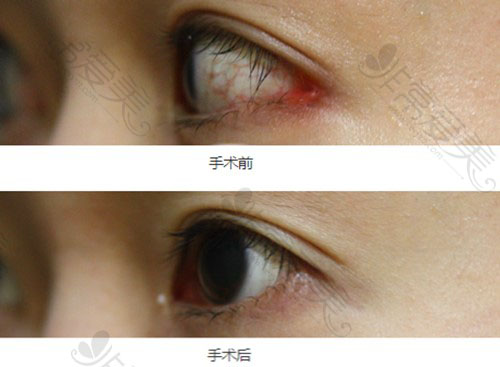 韩国眼角整形谁做的好?有几家医院做眼睛无留疤,露红困扰!