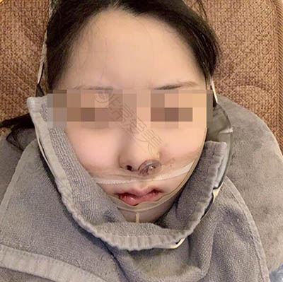 韩国哪家双鄂手术做的好?看我的凸嘴矫正经历效果真心不错!