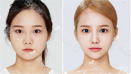 韩国脸骨整形外科