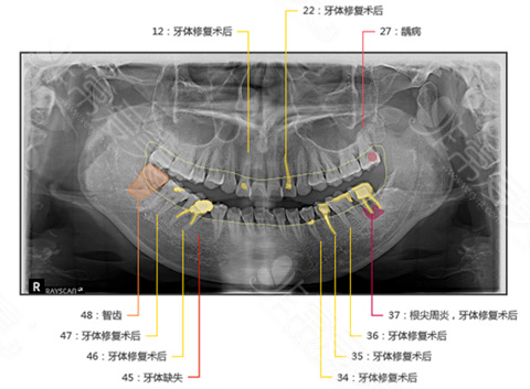 拜博口腔人工智能评估牙齿情况图