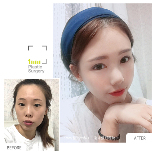 全脸手术前后对比图 全脸手术前后对比图