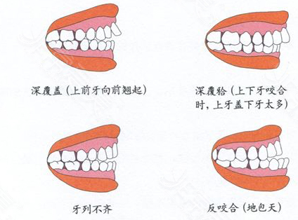 牙齿矫正情况图
