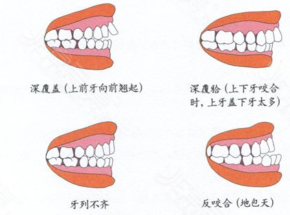 牙齒矯正情況圖