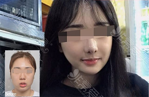 分享一组韩国长脸整容后效果图,长脸变短后变化居然这么大!