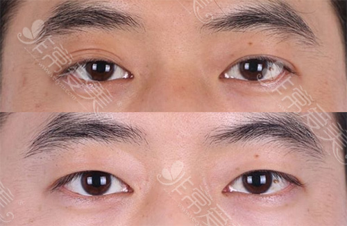 分享几组韩国soonplus金顺东院长双眼皮修复案例照片