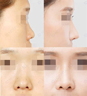 韩国ID整形医院鼻部整形案例