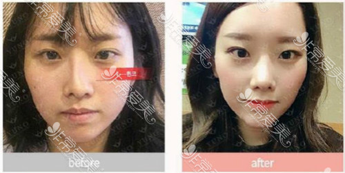 韩国自然风格鼻子整形模版