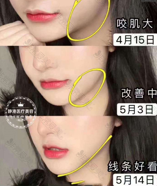沧州静港医疗美容医院瘦脸针前后对比