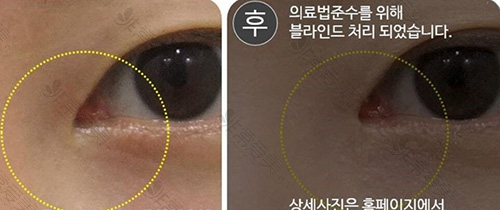 韩国SONE整形外科眼修复照片