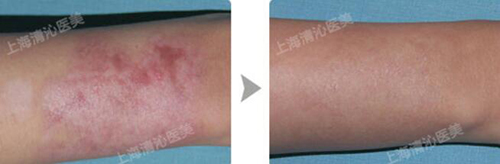 上海清沁整形烧伤疤痕治疗照片