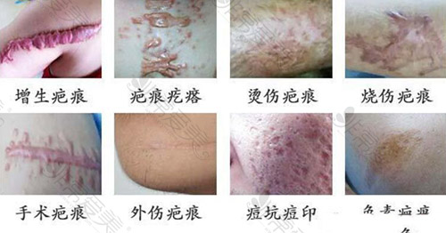 挖掘上海去疤痕宝藏医院,许多人气医生都在这治疗瘢痕疙瘩!