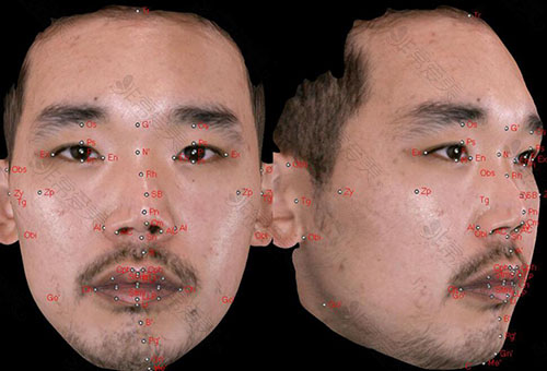 韩国清新整形外科面部3DCT分析