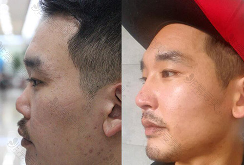 韩国清新整形外科鼻修复前后对比