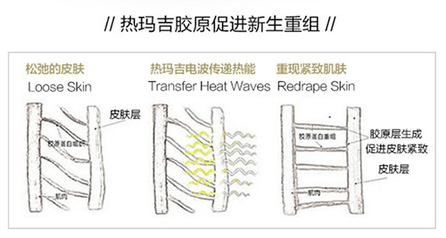 济南艺星医疗美容热玛吉优势