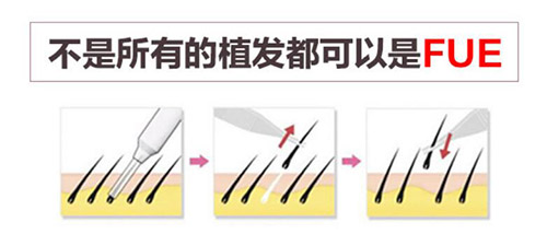 济南艺星医疗美容医院毛发种植方式