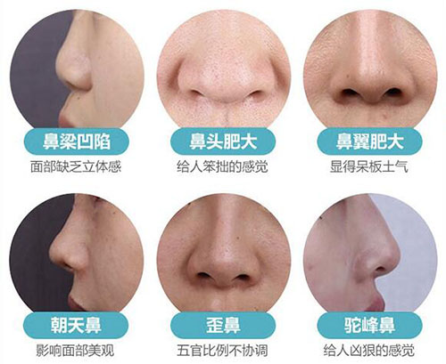 不同的鼻型应该如何手术