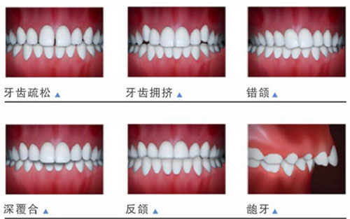 哪些牙齿需要做牙齿矫正