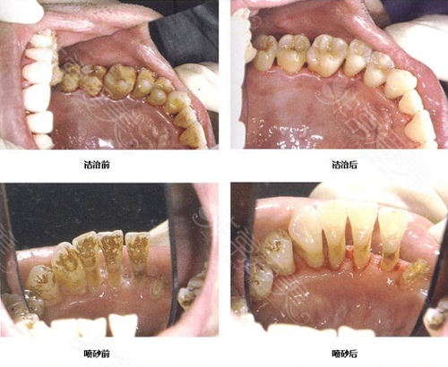 牙齿治疗照片