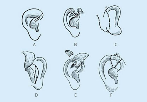上海九慕医疗美容耳整形方案