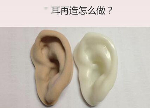 上海华美医疗美容医院耳整形方案