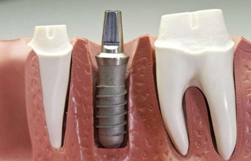 种植牙相关照片
