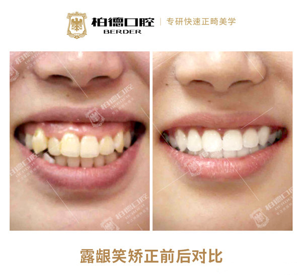 广州柏德口腔牙齿矫正案例对比