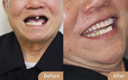 柏德口腔牙齿种植案例前后对比图