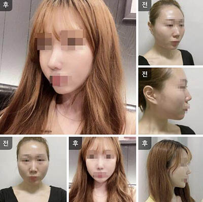 韩国NOTE整形外科轮廓手术案例